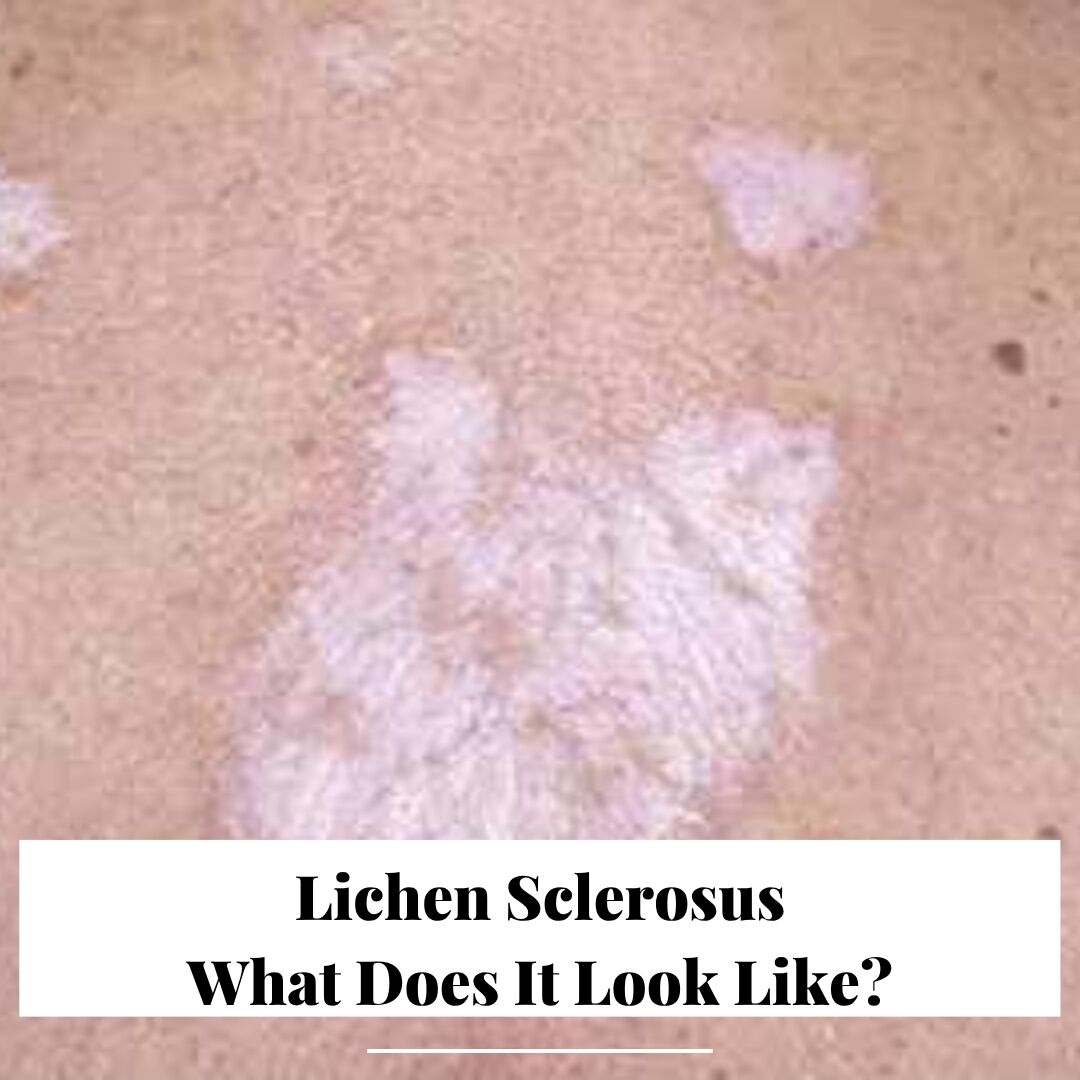 gleitgel lichen sclerosus Lichen Sclerosus | Treatment & Management | Point of Care main image 0