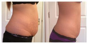 3d lipo after c section Kent | Non-surgical Lipo Ta-da! 3D-lipo body contouring is