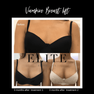 Vampire Breast Lift (VBL): Achieve Youthful Curves Without Surgery